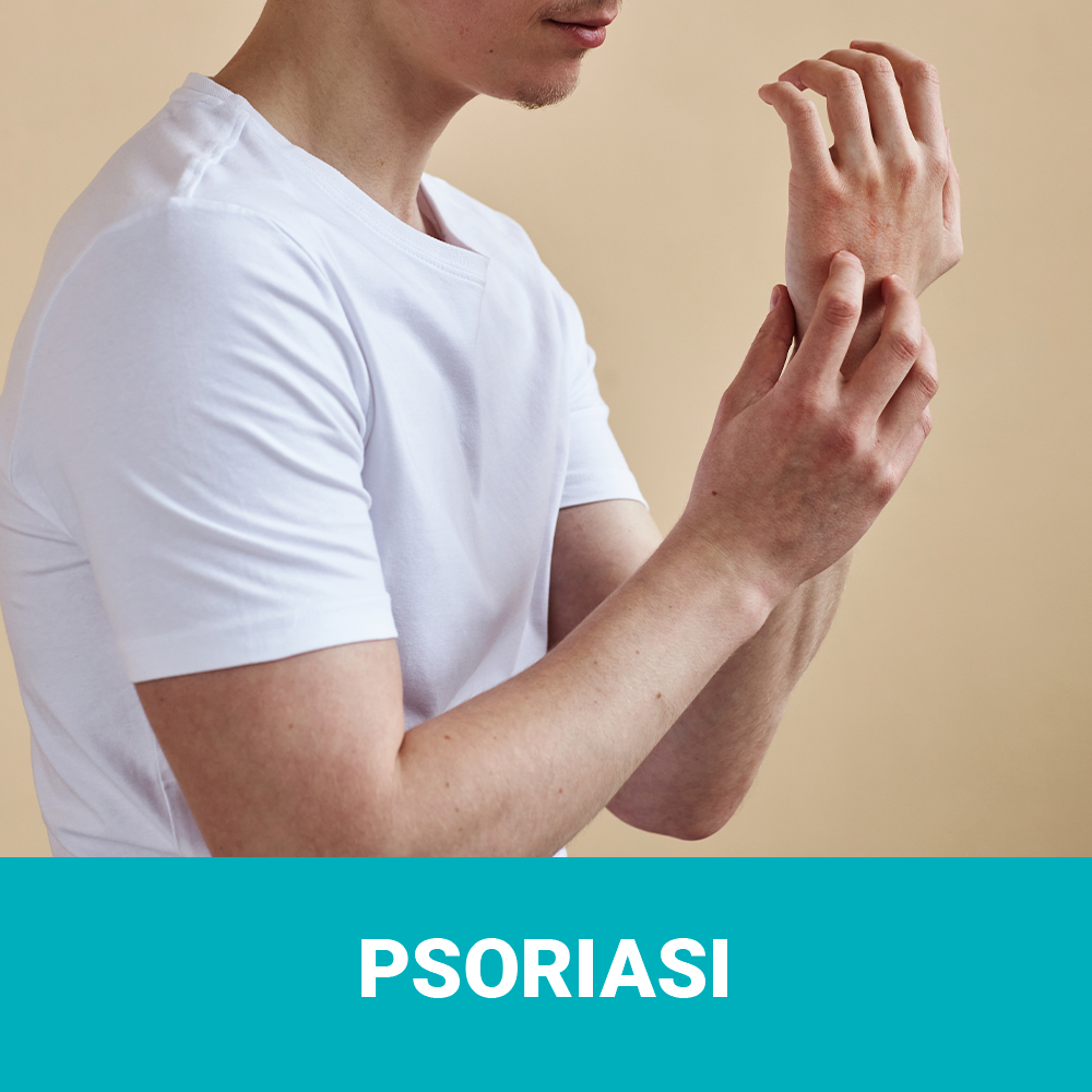 psoriasi